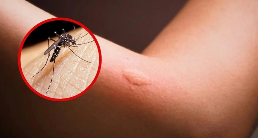 Cuál es la diferencia de una picadura del mosquito del dengue con la de la encefalitis equina