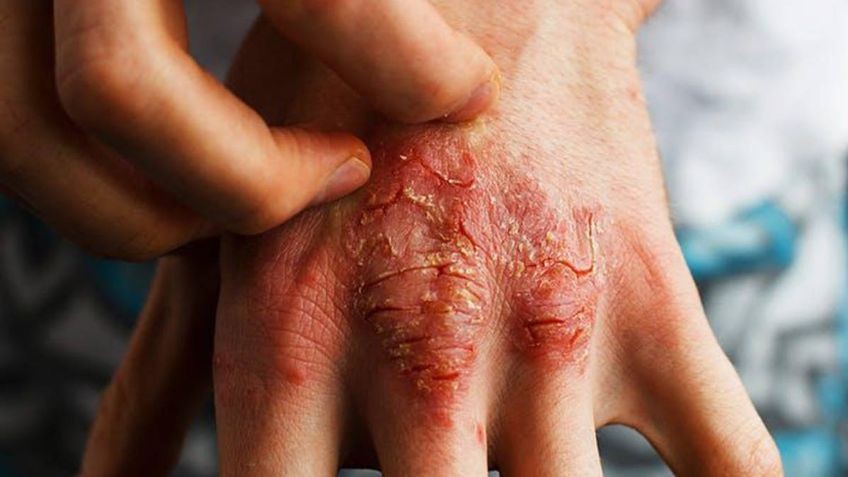 Lanzan campaña nacional contra una agobiante enfermedad de la piel